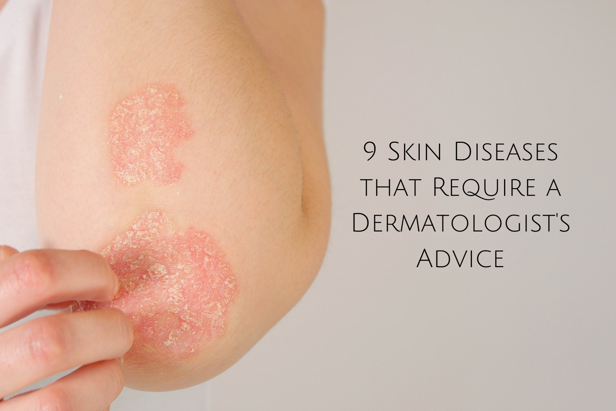 9-skin-diseases-that-require-a-dermatologist-s-advice-kiwla