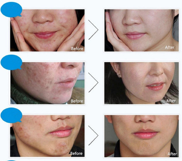 BIOAQUA 3in1 Face Anti Acne Set Scar Removal Spots Pimples Oil Cream Foam Scar Blemish Marks Moisturizing Oil 100g+30g+30ml