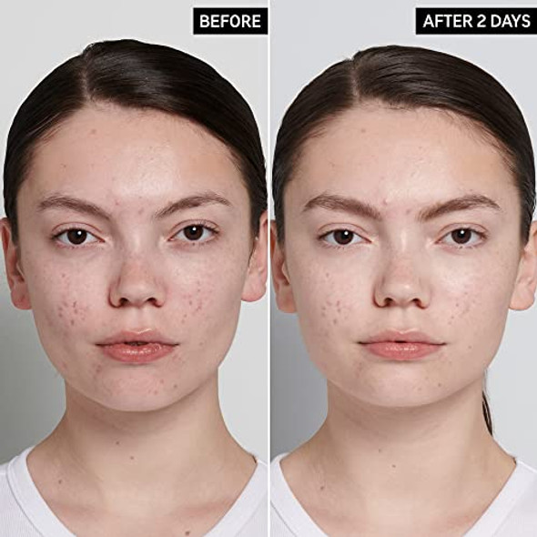 The Inkey List Succinic Acid Treatment 15Ml Clears Blemishes Acne Treatment Vegan Friendly Suitable For All Skin Types
