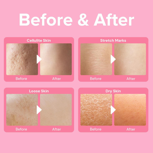 Enaskin Naturals Anti-Cellulite Cream: Firming Solution For Booty Legs & Belly - Skin Tightening & Lifting Body Mask For Toning Lift & Firm Moisturizing Bum Bum Care