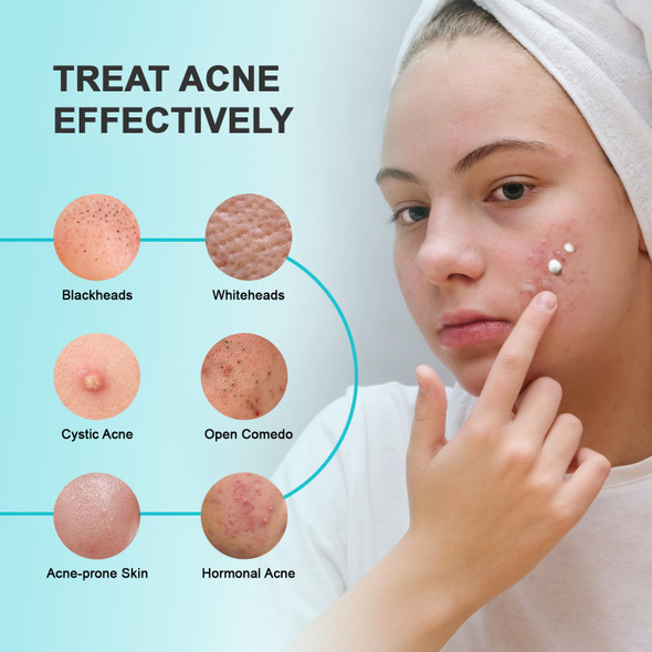 Acne Pimple Spot Treatment Cream: Cystic Hormonal Blackheads Blemish Breakouts For Face Back And Body - 10% Azelaic Acid & Salicylic Acid - Teens-Adults 1.8 Oz