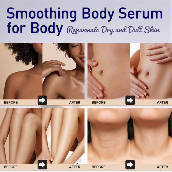 Smoothing Body Serum For Wrinkle: Body Lotion For Dry Skin  Hydrating Body Moisturizer  Daily Hyaluronic Acid Serum With Niacinamide