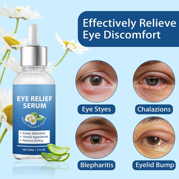 S_Tye Eye Treatment Natural Gentle Ingredient S_Tye Eye Drops Relief Serum For Cleanses Lashes And Eyes Safe & Effective Chalazion And Blepharitis Treatment 30Ml