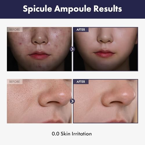 Tosowoong Real Spicule Ampoule With 30000 Shots Niacinamide Panthenol Liquid Skin Booster Serum Pore Minimizer Exfoliating Dead Skin Cells Skin Texture Korean Skincare 30Ml 1.01 Fl. Oz.