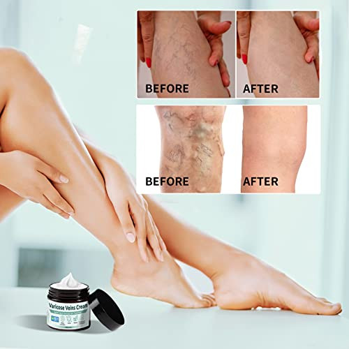 Grocerism Varicose Veins Treatment For Legs - Healing Natural Oils Formula Anti Varicose Vein Soothing Leg Cream Varicose Veins Treatment For Legsã¯¼Ë†1.76 Fl Oz Ã¯¼°
