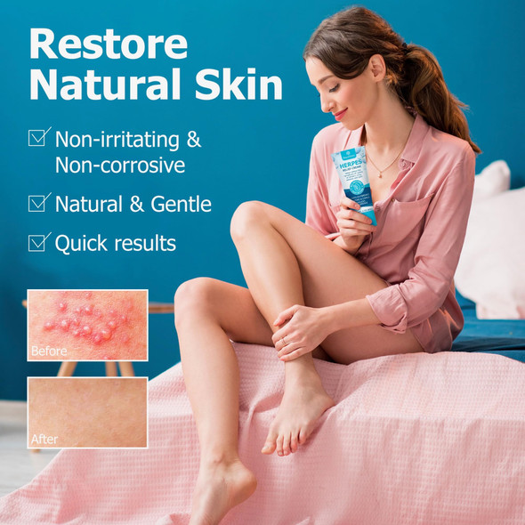 Roycederm Herpes Cream – Soothes Itching Redness Discomfort and Sensitive Areas – Fast-Absorbing & Gentle Formula