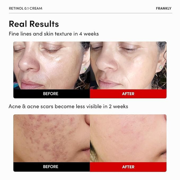Frankly Glowing Skin Duo Retinol 0.1% Cream & Closer Pore Minimizing Serum Pha Peptide 9 Adenosine Anti-Wrinkle & Pore Care Skincare Gifts For Women