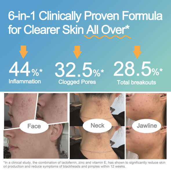 Life Space Acne Relief + Skin Rebalance Probiotic 6 In 1 Scientific Formula &