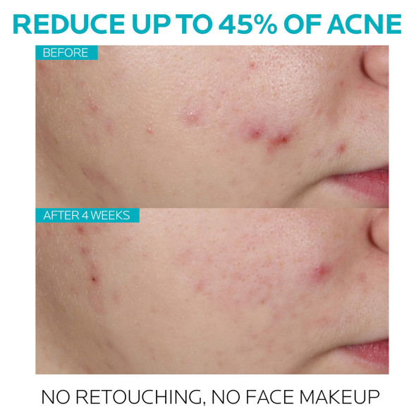 La Roche-Posay RochePosay Effaclar 1.5% Salicylic Acid Serum Acne Treatment For Face With
