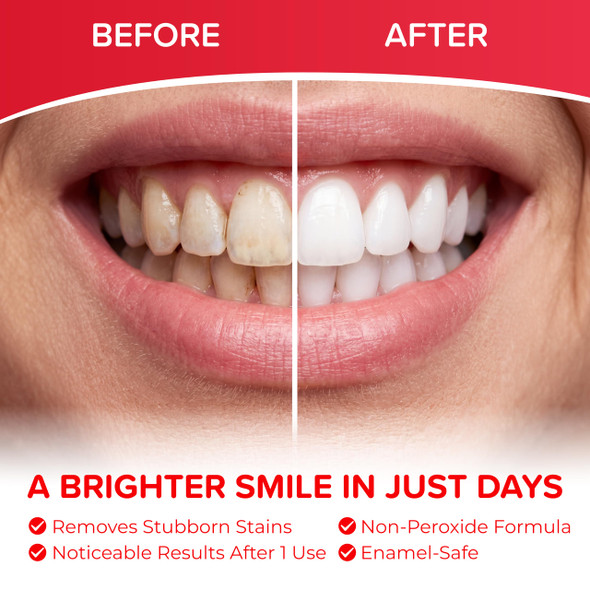 Whites Beaconsfield Teeth Whitening Strips - 60 Strips, 30 Day Treatment