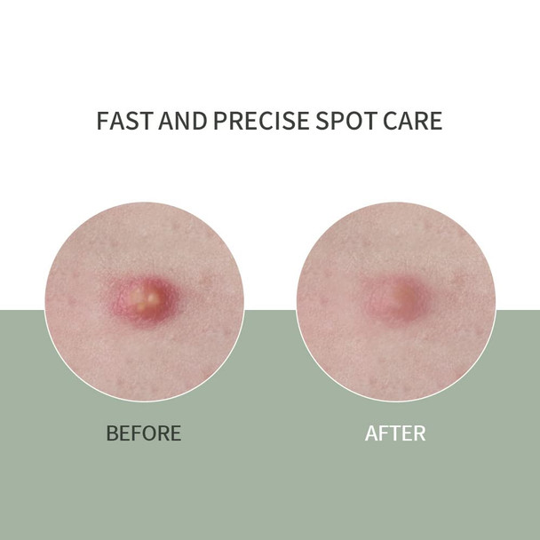 SCINIC Cica Blemish Clear Spot Patch 4mg  9patch  Fast Care For Spot Areas Of Concern  Spot Patch For The Intensive Care Of Local Areas  Korean Makeup