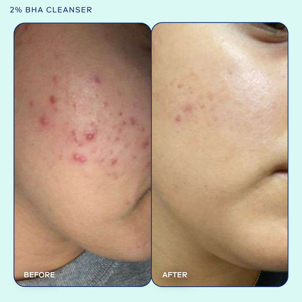 Skinfix Acne+ 2% BHA + Azelaic Acid + Niacinamide + AHA Cleanser 148 ml