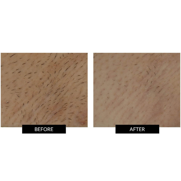 SmoothSkin Bare+ Nude Ultrafast IPL Device Exclusive Collection, Hongmall
