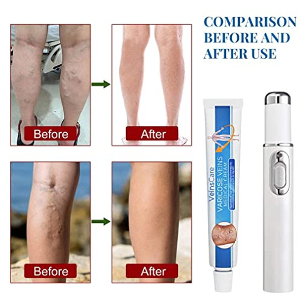 Veinshealth Varicose Veins Blue Light Therapy, Varicose Veins Cream With Veins Pen (1cream+1pen)