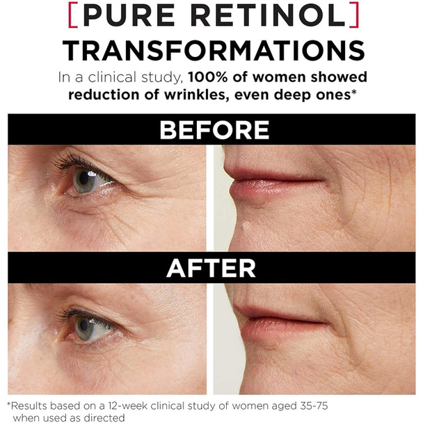 L'Oreal Paris Revitalift Triple Power Lzr Retinol Night Serum For Face With 0.3% Pure Retinol Moisturizes Skin And Eliminates Deep Wrinkles For All Skin Types 30Ml