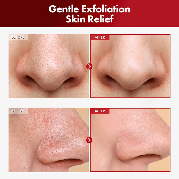 Shashak Toner Pads, Exfoliating Facial Wipes With Salicylic Acid And Centella Asiatica, Cleansing For Makeup And Blackheads, Exfoliate And Moisturize, Dual-Sided, 70 Pads, 155Ml, 5.2 Fl. Oz.