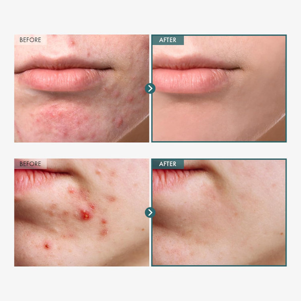 Adenosine Cica Cream, 520,000Ppm Centella Asiatica, Redness Reducing For Oily And Dry Skin Moisturizer, Barrier Cream With Niacinamide And Panthenol, Korean Skincare, 100Ml, 3.38 Fl. Oz. Adenosine Cica Cream, 520,000Ppm Centella Asiatica, Redness Reducing For Oily And Dry Skin Moisturizer, Barrier Cream With Niacinamide And Panthenol, Korean Skincare, 100Ml, 3.38 Fl. Oz.