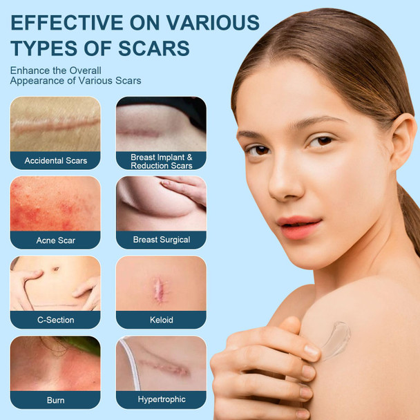 Advanced Scar Cream, Silicone Scar Gel, Treats Old And Scars, Reduces The Appearance Of Scars From, Body, Face, Stretch Marks, Surgical Scar, Keloids, Acne, Burns And More, 1.7 Oz