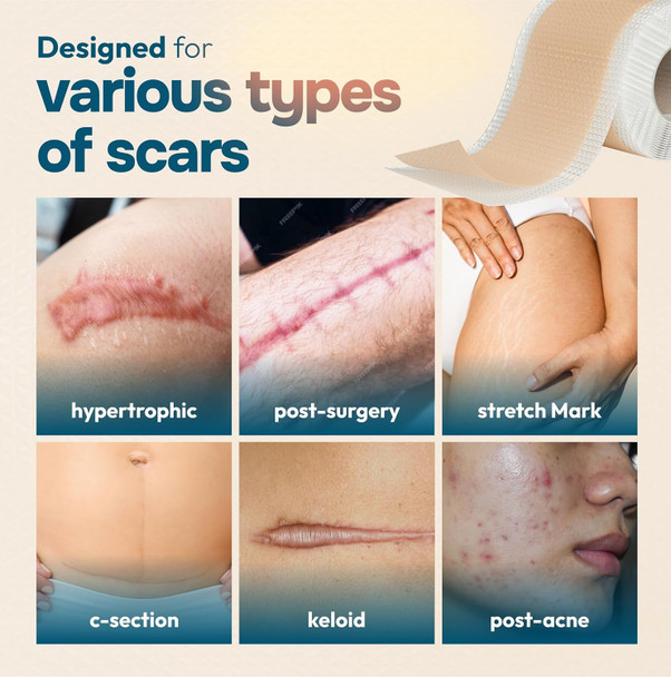 Silicone Scar Tape Reusable Sheets (120” X 1.6”) Medical Grade Silicone Scar Sheets For Surgical Scars, Burns, Tummy Tuck, Keloid, C-Section - Cut To Size Scar Treatment