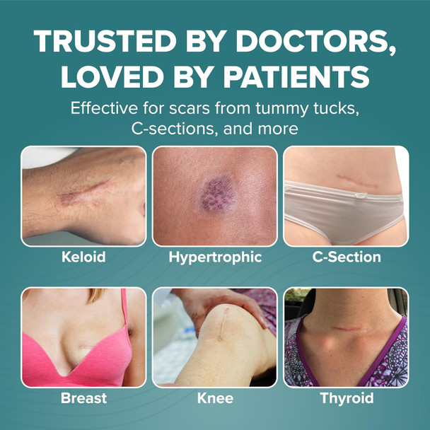 Epi-Derm C-Strips, Premium Grade Silicone Scar Sheets For C-Section, Tummy Tuck, Cardiac Surgery Scars, Easy To Use & Reusable Silicone Gel Sheets For Scars, 1.4 X 6 In - 1 Pack, Natural