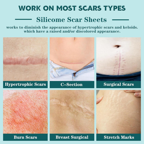 Silicone Scar Sheets,(1.6" X 120" Roll- 3M) Silicone Scar Tape For Surgical Scars,Silicone Scar Removal Strips For Surgical,C-Section,Tummy Tuck,Keloid Scars Keloid Bump Removal