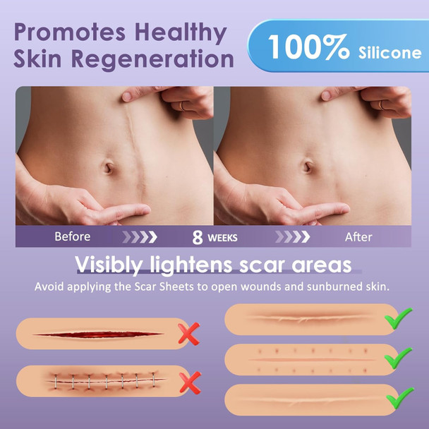 Silicone Scar Tape For Surgical Scars - 1.6" X 120" 300Cm Roll - Reusable - Ultra Thin & Soft Scar Sheets For C-Sections, Tummy Tuck, Keloids, Scar Treatment Both Old And Scars - 1 Pack