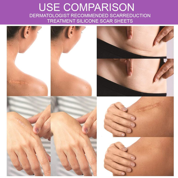 Silicone Scar Tape For Scar Treatment, Advanced Scar Removal Sheets, Soften And Flattens Old Scars And Scars Which Resulting From Surgery, Acne, Injury, Burns, C-Section And More (1.6”X 60”)