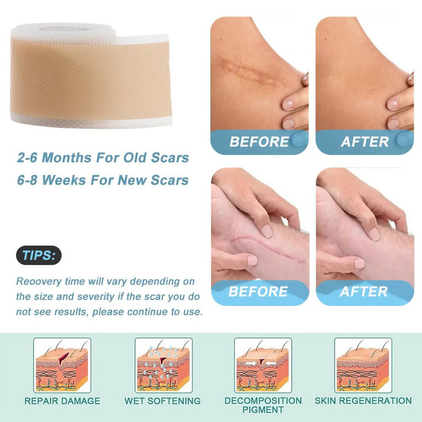 Silicone Scar Tape, Silicone Scar Sheets, Reusable Silicone Scar Tape, Tattoo Concealer Tape For All Kinds Of Scars, Like Blemish Scars And Birthmarks Etc Scar Tape Strips (1.6  60 Roll)