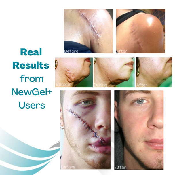 Newgel+ Advanced Silicone Professional Scar Treatment Tape For Abdomen And Extremity, Post Surgery, C-Section, Injury, Keloids, Burns, Reusable, 2" X 18" Strip - Clear