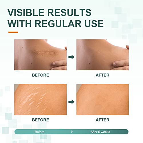 Silicone Scar Sheets,Tape, Strips - Healing Keloid, C-Section And Tummy Tuck - As Surgical Cream, Gel, Patch, Bandage, Pad - Surgery Scars Treatment - 6 Pack