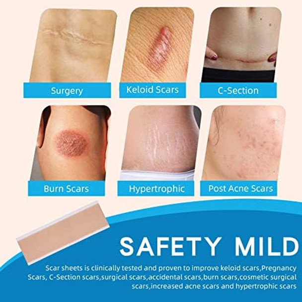 8 Pack Silicone Scar Sheets (8 Pack - 5.9" X 1.57"), Soonuly Medical-Grade Silicone Scar Bandage Sheets For Surgery Keloid C-Section Hypertrophic Burns Scar Tape For Old Scars Silicone Bandage