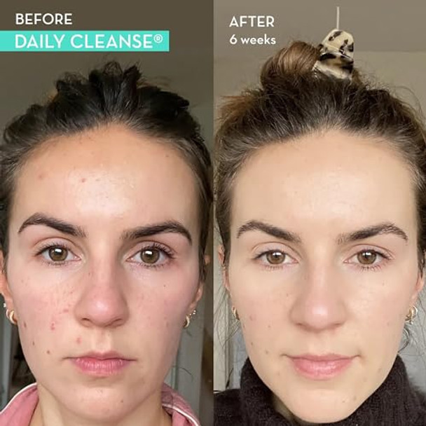 Hum Full Skin And Liver Detox From Nutrition: Wingman And Daily Cleanse A Green Detox + Milk Thislte For Skin And Liver Health.