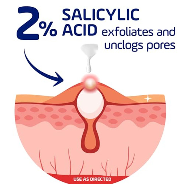 Asepxia Acne Treatment Cream For Face 2% Salicylic Acid Rapid Maximum Strength Acne Treatment Clears Pimples And Blackheads Prevents Acne And Controls Excess Oil 1 Oz Asepxia Acne Treatment Cream For Face 2% Salicylic Acid Rapid Maximum Strength Acne Treatment Clears Pimples And Blackheads Prevents Acne And Controls Excess Oil 1 Oz