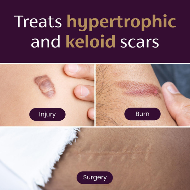 Mederma Medical Grade Silicone Small Scar Sheet 1.4x3 inches (4 Counts) for Injury Burn and Surgery Scars