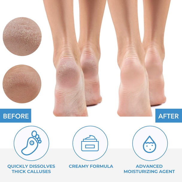 Forpro Professional Collection Premium Callus No More Callus Remover Fast-Acting Callus Removing Formula 32 Oz. Forpro Professional Collection Premium Callus No More Callus Remover Fast-Acting Callus Removing Formula 32 Oz.