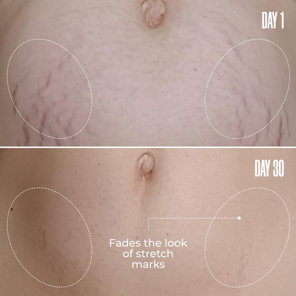 Maëlys Cosmetics B-Flat Belly Firming Cream - Stretch Mark Tightening Belly Cream