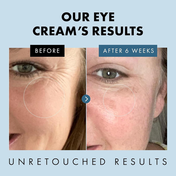 Eclat Skincare Under Eye Cream For Dark Circles & Puffiness – Anti Aging Formula For Wrinkles - Moisturizer For Fine Lines Crows Feet & Eye Bags – Hydrating Treatment For Firming & Smoothing - 30Ml