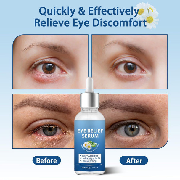 S_Tye Eye Treatment Natural Gentle Ingredient S_Tye Eye Drops Relief Serum For Cleanses Lashes And Eyes Safe & Effective Chalazion And Blepharitis Treatment 30Ml