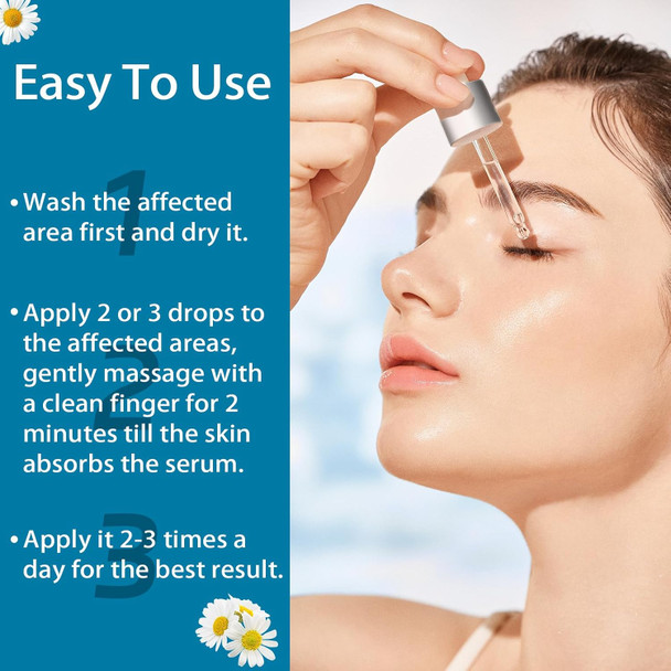 S_Tye Eye Treatment Natural Gentle Ingredient S_Tye Eye Drops Relief Serum For Cleanses Lashes And Eyes Safe & Effective Chalazion And Blepharitis Treatment 30Ml