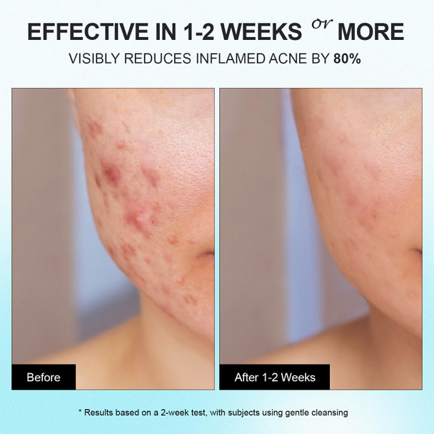 Acne Pimple Spot Treatment Cream: Cystic Hormonal Blackheads Blemish Remover For Face Back And Body - With 10% Azelaic Acid - Teens 13-19 & Young Adult 20-30 1.8 Oz