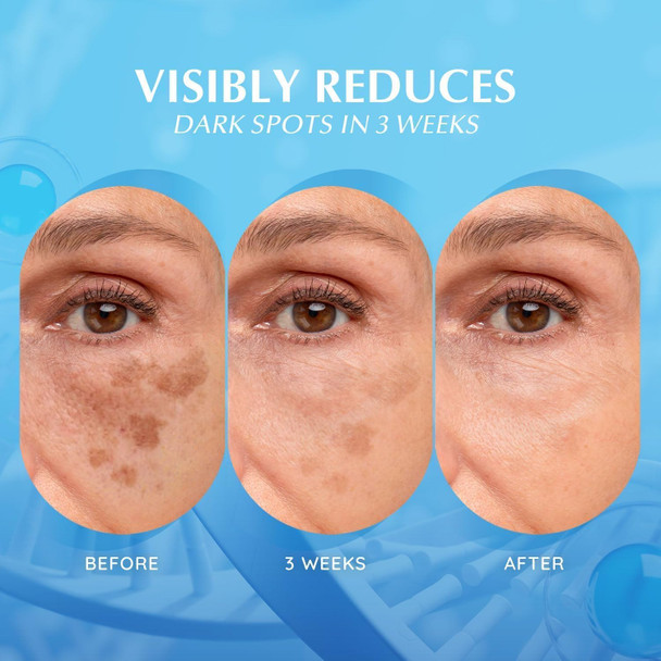 Enaskin Dark Spot Remover For Face: Hyperpigmentation Body Treatment For Freckles Melasma Age Spot Sun Spot - Dark Spots Corrector Serum For Women And Men (1.0 Fl Oz)