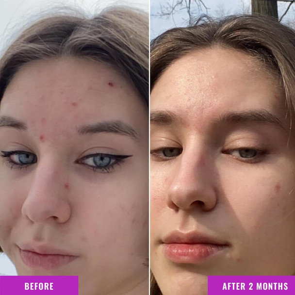 Good Molecules Niacinamide Serum - 10% Niacinamide To Target Acne Nourishment And Skin Tone - Ultra Hydrating Serum And Brightening Skin Care For Face