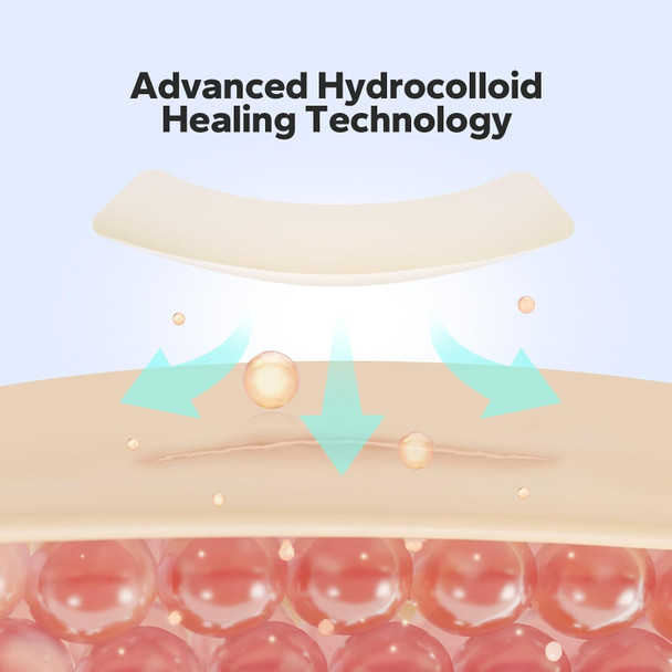 Komoko Hydrocolloid Bandages (10 Count) Hydrocolloid Patch For Blisters Acne Cuts & Scrapes Hydrogel Wound Dressing With Self-Adhesive For Faster Healing Waterproof & Latex- (4' X 4') Komoko Hydrocolloid Bandages (10 Count) Hydrocolloid Patch For Blisters Acne Cuts & Scrapes Hydrogel Wound Dressing With Self-Adhesive For Faster Healing Waterproof & Latex- (4' X 4')