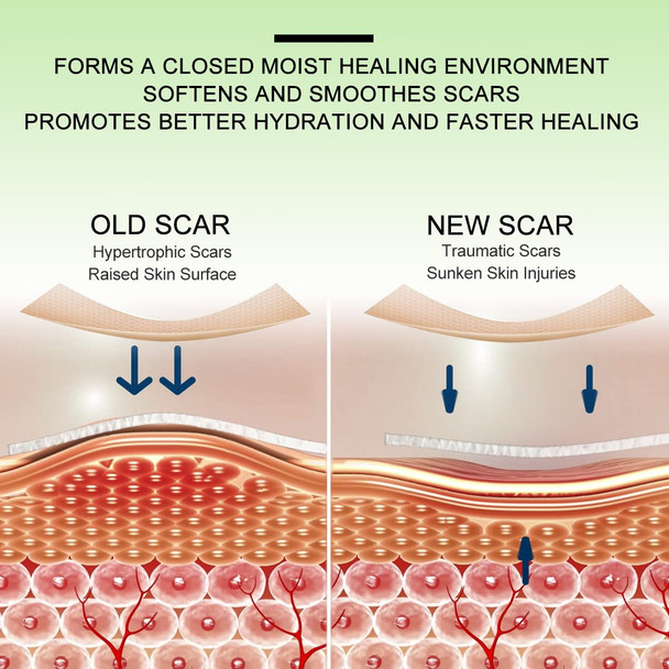 Silicone Scar Sheets(1.8” X 157”Inch- 4M) Scar Tape Scar Strips Medical Grade Scar Remover C-Section Surgery Keloid Tummy Tuck Scar Patch.