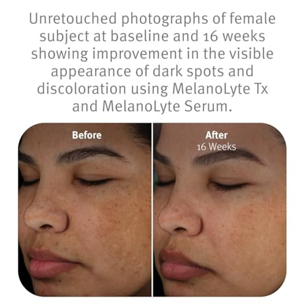 Epionce MelanoLyte Tx - Botanical-Based Product for Uneven Skin Tone, For All Skin Types, Contains Licorice Root Extract, Dermatologist Skincare