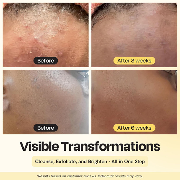 Gleamin Vitamin C Face Wash & Facial Cleanser - Cream To Foam 2% Salicylic Acid Cleanser With Paw Paw & Turmeric - Gentle Exfoliating Facewash For Women & Men Oily & Combination Skin 3.4 Fl Oz