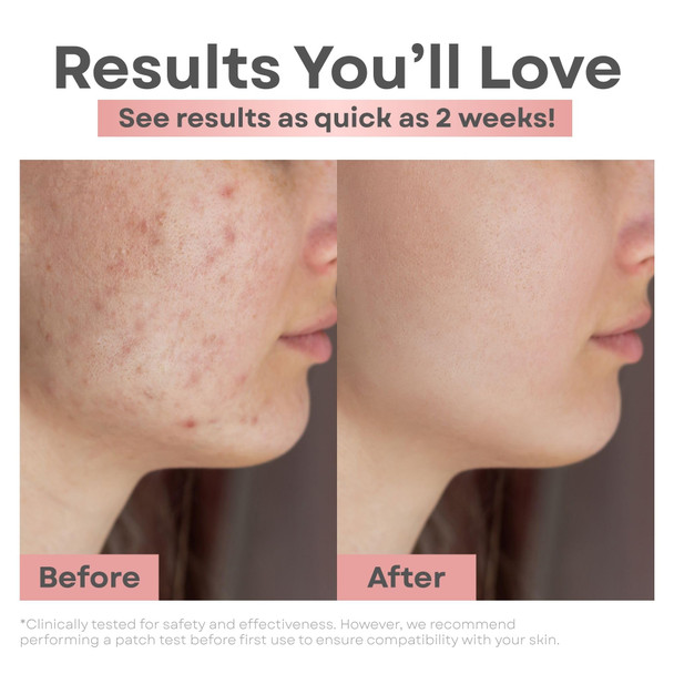 Clear Essence Platinum Blemish Control Wash Formula Acne Face Wash 5oz Facial Cleanser for Oily Skin Acne & Blemishes Gentle Foaming Acne Cleanser for Teens Women & Men Daily Skin Care Solution