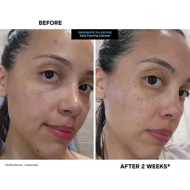 Kate Somerville EradiKate 3% Sulfur Daily Foaming Cleanser Acne Treatment – Clinically Formulated Medicated Face Wash Balances Skin & Cleans Pores, 4 Fl Oz