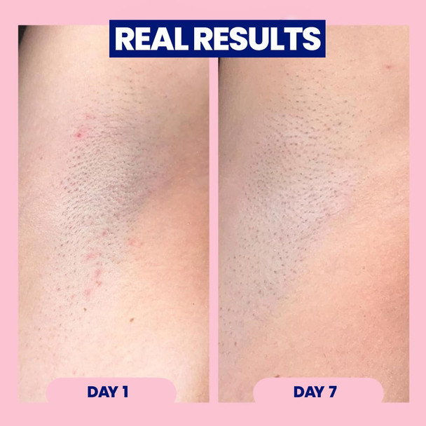 Megababe Après Shave | Post-Shave & Waxing | Ingrown Hair & Razor Bump Roll-On Treatment for Women | Bikini Armpits & Legs (1.7 fl oz)