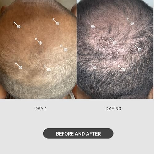 Ds Laboratories Stimuroller Hair Micro-Needle Hair Stimulation System 0.25Mm Packaging May Vary